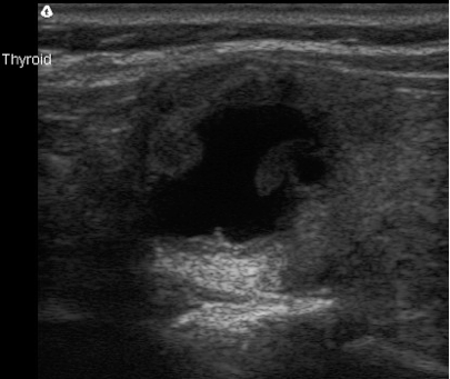 thyroid-disease